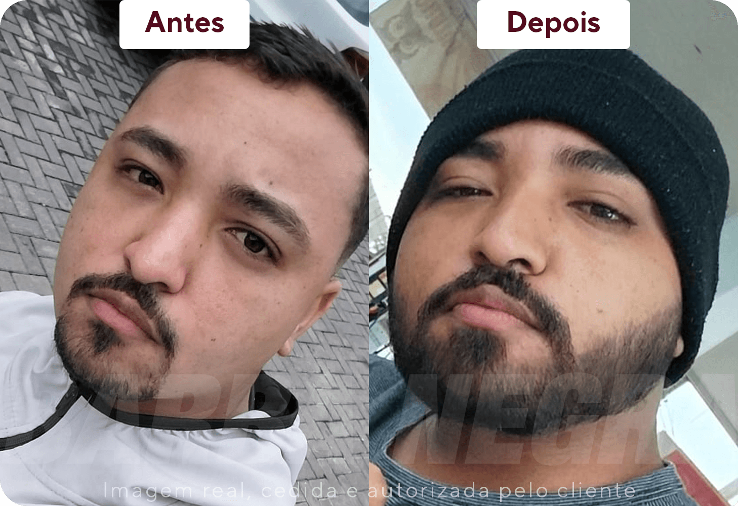 Resultados Barba 3